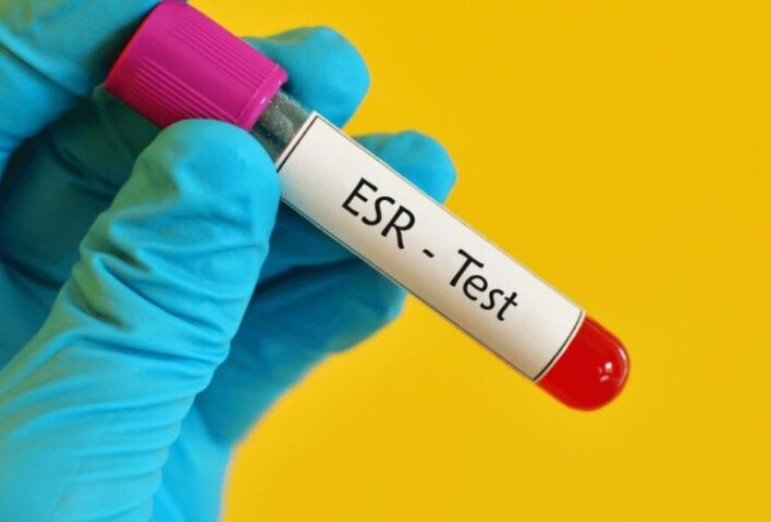 sedimantasyon testi