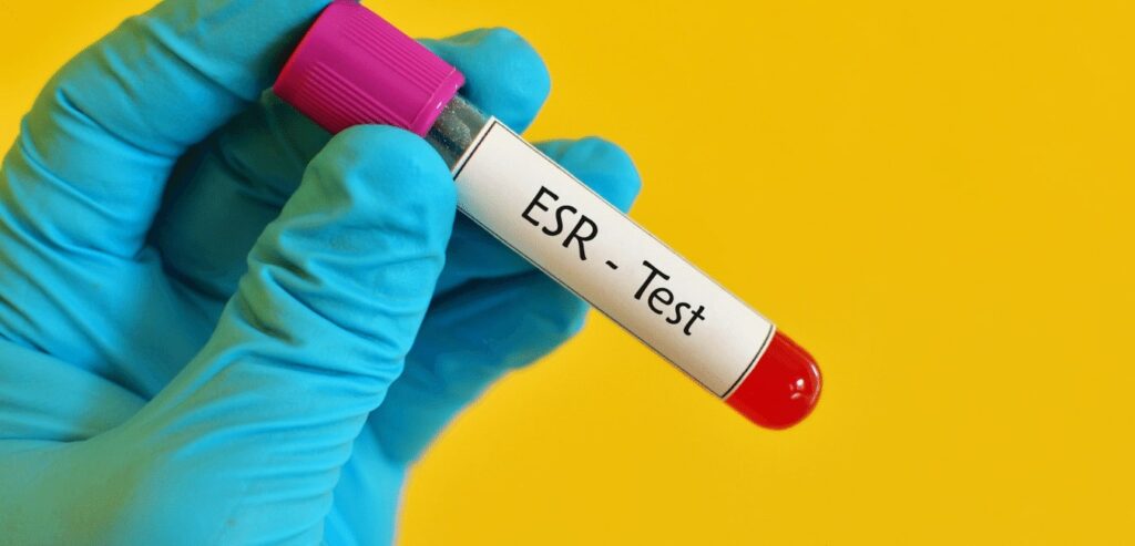 sedimantasyon testi